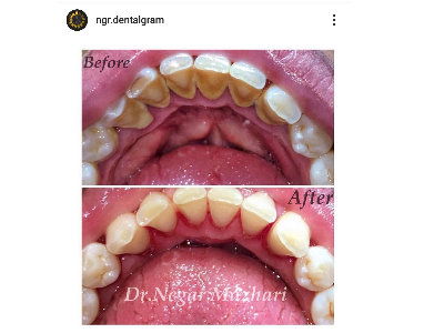 Scaling and Polishing (Teeth cleaning)