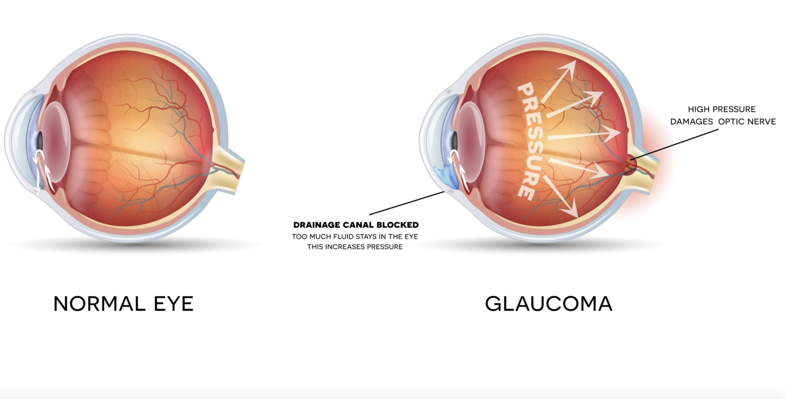 Классификация глаукомы офтальмология. Заболевание глаз глаукома. Можно вернуть зрение при глаукоме